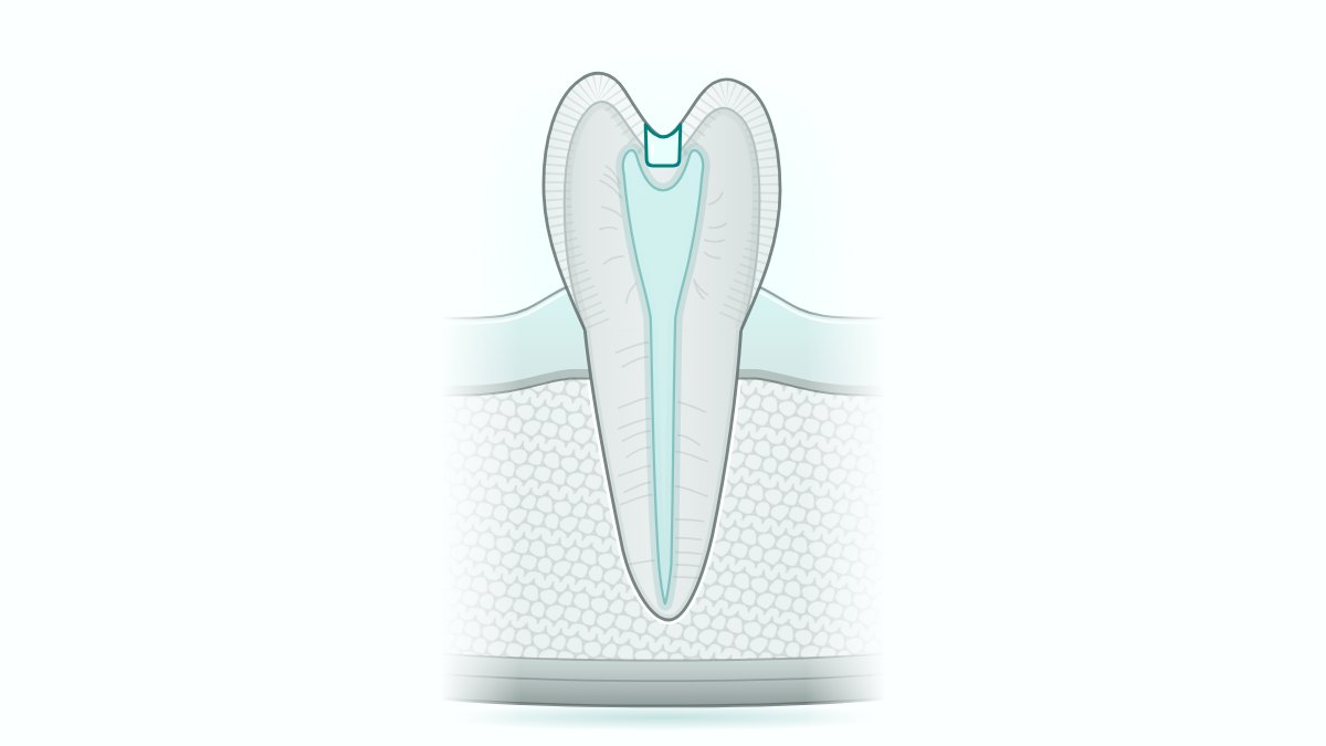 Dente restaurado doendo: restaurar não impede cárie nova