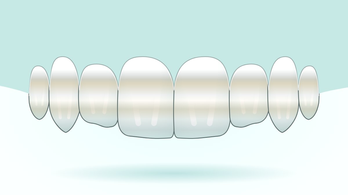 Dentes manchados por tetraciclina: o que o clareamento faz