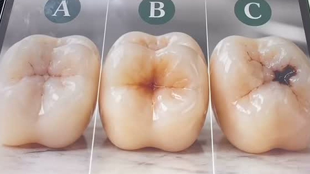 Sulco escuro no dente: como saber se é cárie